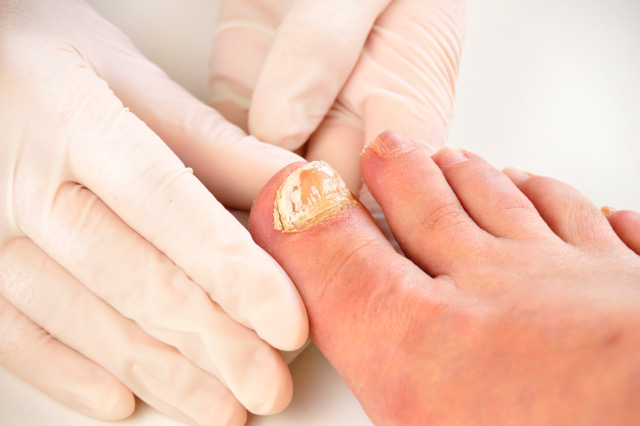 Fingal Nail Foot Issues