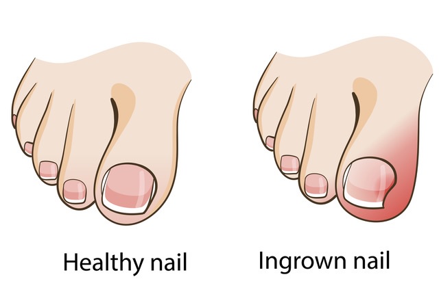 Ingrowing Toenails